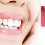 How To Find Best Dentist For Veneers In Turkey