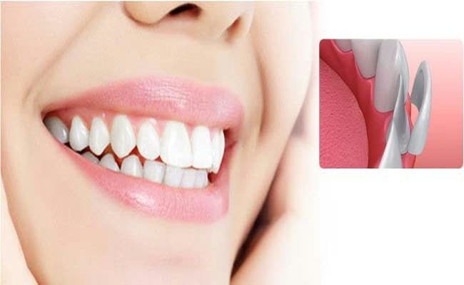 How To Find Best Dentist For Veneers In Turkey